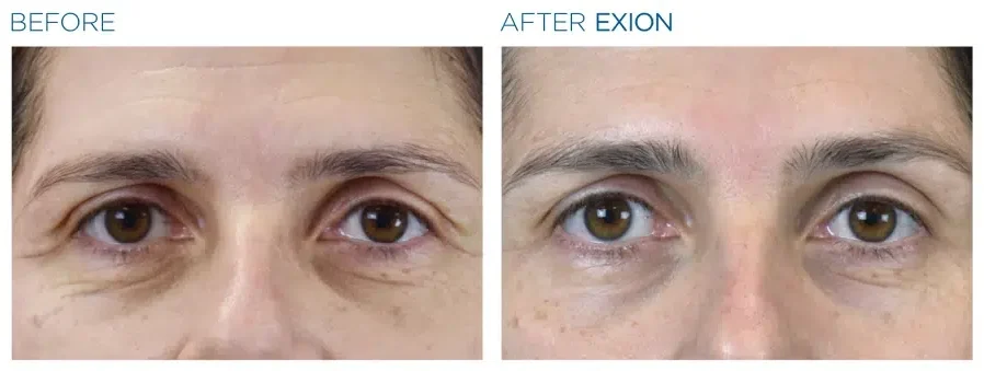 Exion Face Before And After 1 Emana Medical Beverly Hills Ca