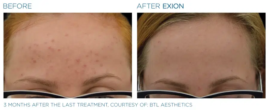 Exion Face Before And After 4 Emana Medical Beverly Hills Ca 1