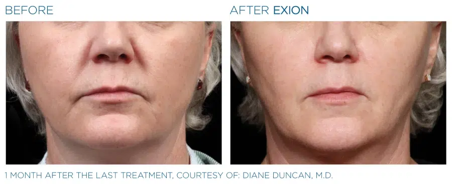 Exion Face Before And After 6 Emana Medical Beverly Hills Ca