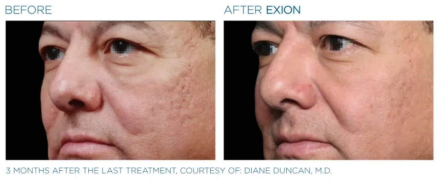 Exion Microneedling Before And After 3 Emana Medical Beverly Hills Ca