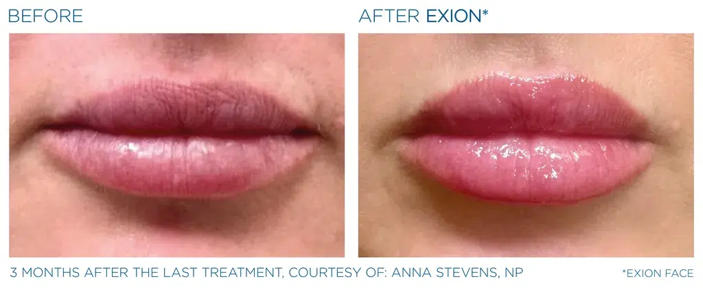 Exion Lips