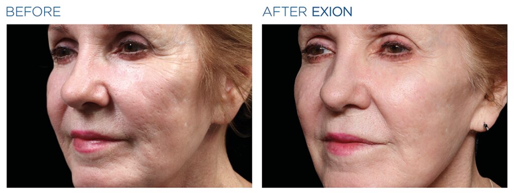 Exion Pic Ba Card Cheek Female 004 Frf Enus100 1024x419