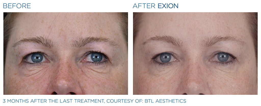 Exion Pic Ba Card Eyes Female 026 Face Enus100 1024x419
