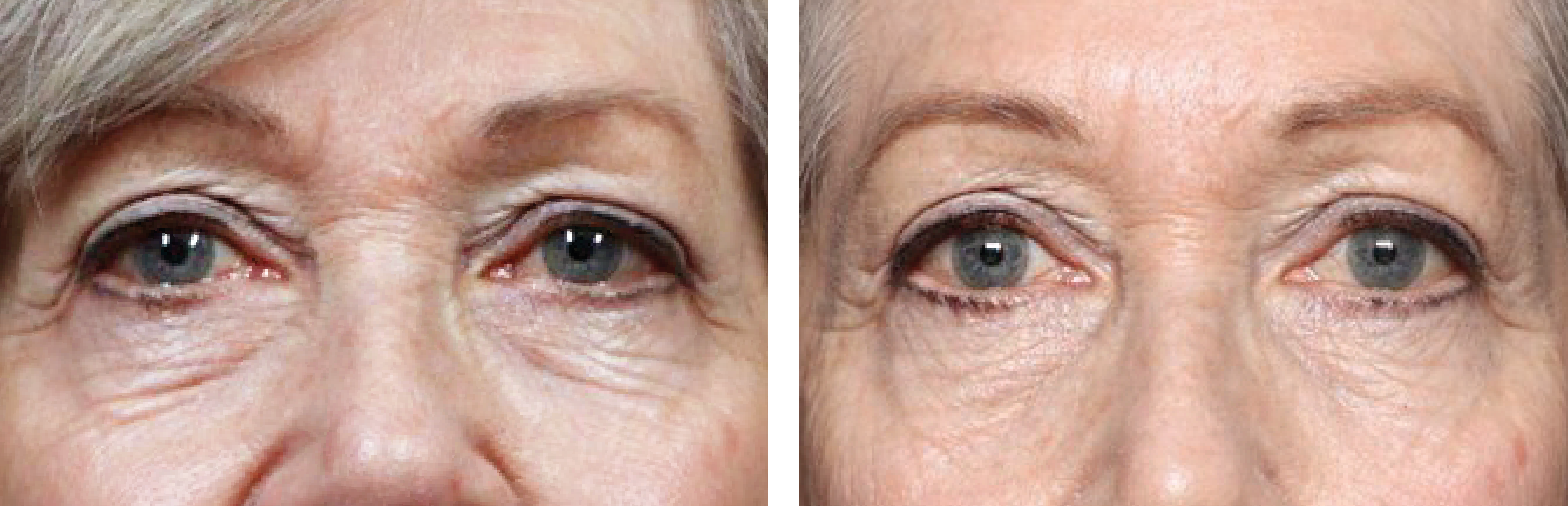 Huidverstrakking Before And After